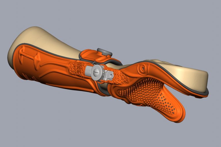 Redressionsorthese mit integrierten Gelenken, konstruiert mit Geomagic Freeform und überlagert mit Zweckform